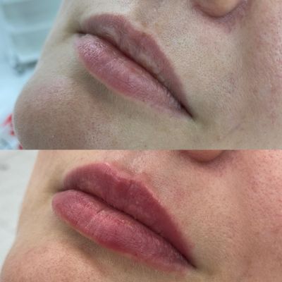 Коррекция объема губ, фото 2 — Esthetology