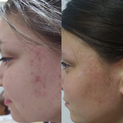 Лечение акне (результат через 2 недели), фото 3 — Esthetology