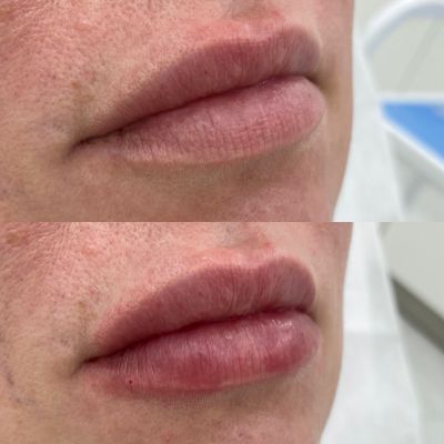 Коррекция объема губ, фото 1 — Esthetology