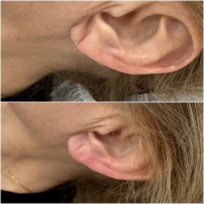 Коррекция возрастных изменений мочки уха, фото 4 — Esthetology
