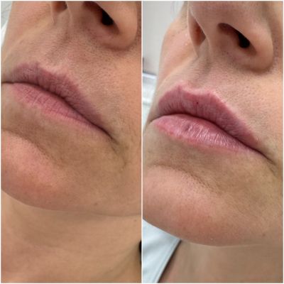 Коррекция объема и асимметрии губ, фото 5 — Esthetology