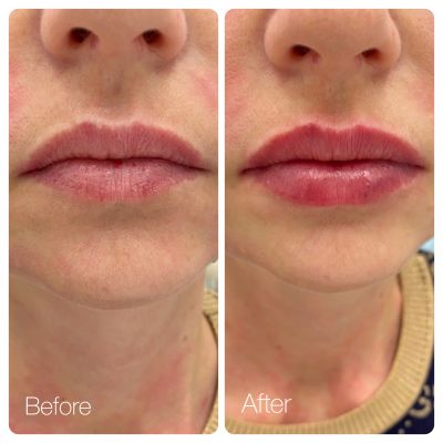 Коррекция объема и увлажнение губ, фото 9 — Esthetology