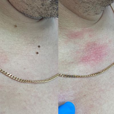 Удаление новообразований, фото 6 — Esthetology