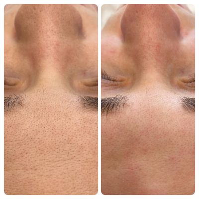 Результат работы ботулотоксина, фото 10 — Esthetology