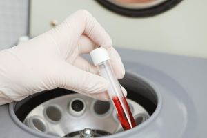 Плазмолифтинг волос, фото 7 — Esthetology